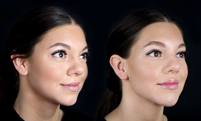 XO Lips ger naturliga resultat